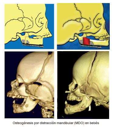 https://natureline.store/SiteCollectionImages/Infant_Mandibular_Distraction_Osteogenesis_es.jpg
