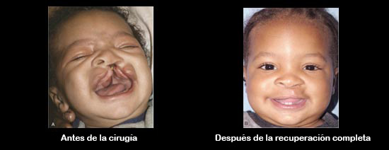 https://natureline.store/SiteCollectionImagesArticleImages/CleftbeforeAfter_Baby_es.jpg