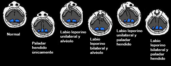 https://natureline.store/SiteCollectionImagesArticleImages/CleftlippalateABCDEF_es.jpg