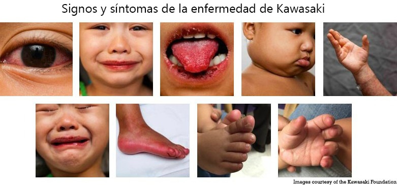 https://natureline.store/SiteCollectionImagesArticleImages/Signs_Symptoms_Kawasaki_Disease_es.jpg