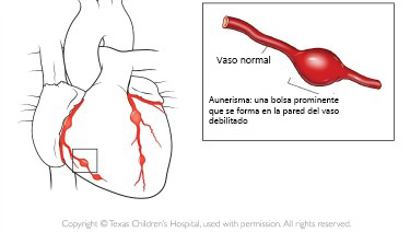 https://natureline.store/SiteCollectionImagesArticleImages/aneurysm_texaschildrens_es.jpg