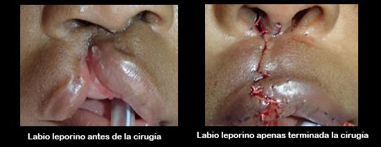 https://natureline.store/SiteCollectionImagesArticleImages/cleftLipBeforeAfter2_es.jpg